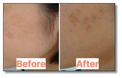 색소침착 레이저