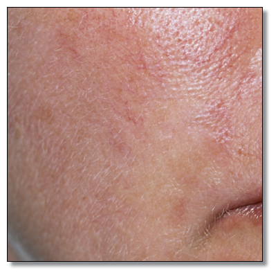 색소침착 레이저